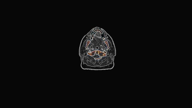 Mri Scan Monitor with Scan image of Brian