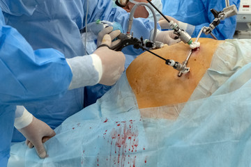 Surgical room surgical table with a fat woman. Medical background. Hands of several surgeons with...