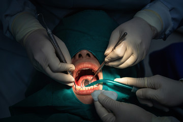 Closeup Dentist and assistant operating for checking and teeth cleaning at dental clinic, Tooth care concept.