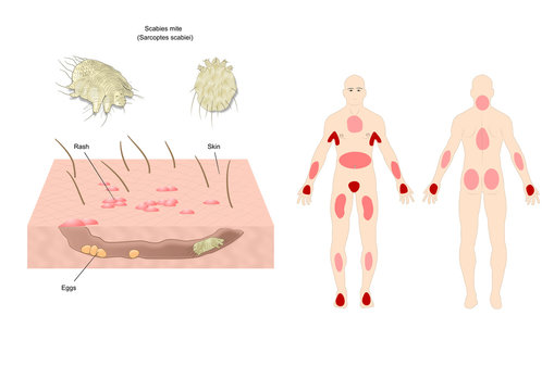 scabies mite (scientific name: sarcoptes scabiei), a contagious skin infestation