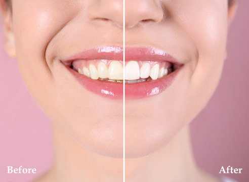 Smiling young woman before and after teeth whitening procedure on color background, closeup