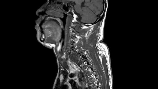 Magnetic resonance (MRI) of Cervical spine the c-spine injury and dislocation