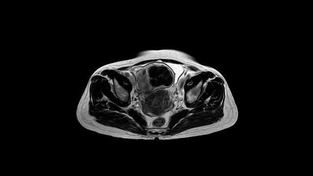 MRI Whole Abdomen finding mass or tumor in side.