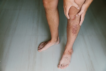 man holds his leg with bruises and wounds