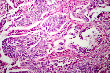 Lung adenocarcinoma, light micrograph, photo under microscope