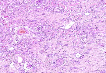 Histology of human tissue, show cortical necrosis of kidney as seen under the microscope, 10x zoom