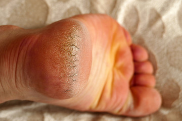 neglected and chapped human foot heel, crack heel pictures,
