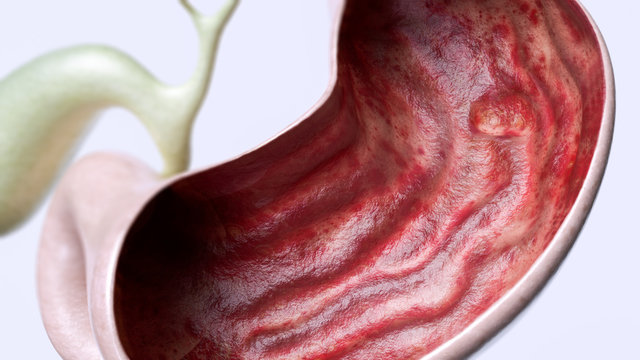 Stomach ulcer stage 2 of 3 - high degree of detail - 3D Rendering