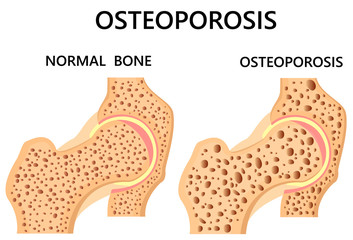 Hip bone. healthy and with osteoporosis