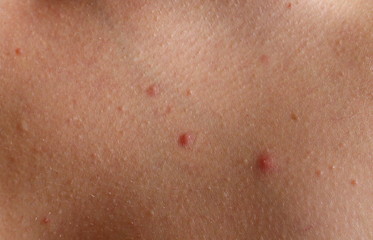 Haut mit Pickeln