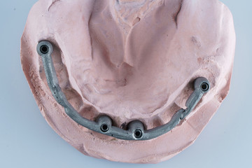 frame made of metal for strength for Dental prosthesis, filmed on top model