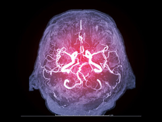 Magnetic resonance image (MRI) of Vessel in the brain axial view or MRA brain.