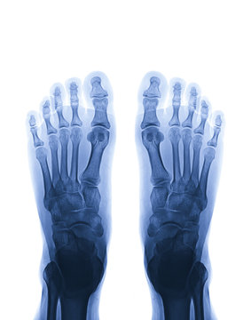 Radiographic image or film x-ray of both foot AP view . Gouty arthritis concept