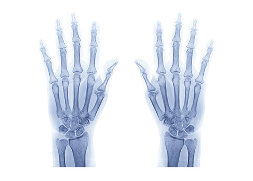 radiographic or X-ray image of both hand isolated on white background .