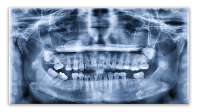 Panoramic dental x-ray image or orthopantomogram of jaw with all teeth  used in dentistry for diagnosis of diseases, disorders and conditions of the oral cavity