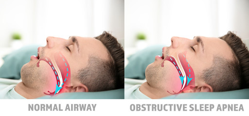 Illustrations showing difference between normal breathing and obstructive sleep apnea - obrazy, fototapety, plakaty