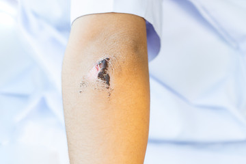 wound have scab on the elbow of the child