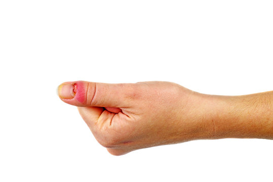 Female palm with panaritium on thumb finger. Isolated on white background