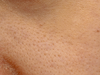close up wide pores skin on dry face of Asian woman, Female nose and cheek skin problem, large...