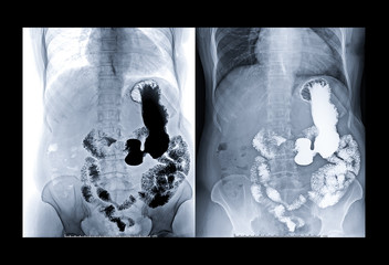 X-ray image of upper gastro-intestinal s a procedure in which a doctor uses x-rays, fluoroscopy, and a chalky liquid called barium comparison invert filter and  non filter.