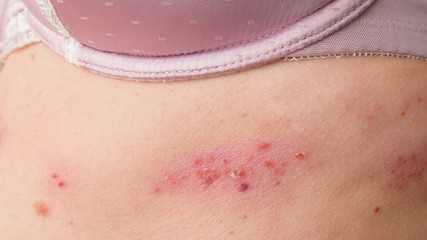 skin rash treatment on woman body. Shingles,  Disease, Herpes zoster, varicella-zoster virus. skin...