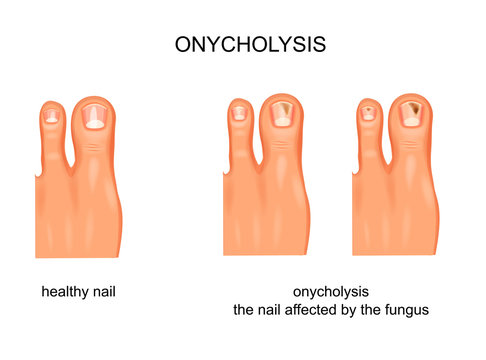 fungal nail infection, onycholysis