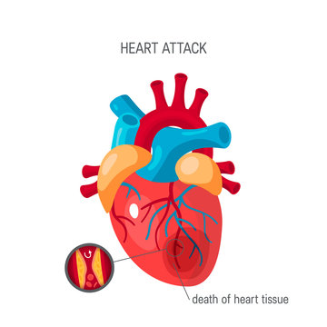 Heart attack concept in flat style, vector