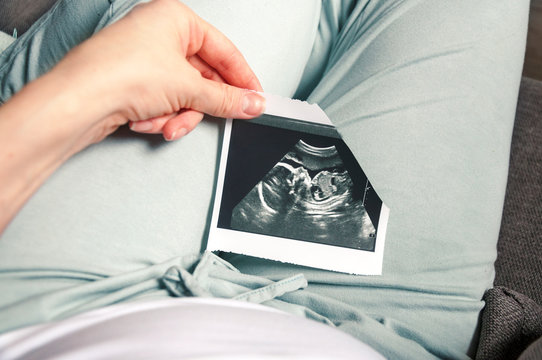 A girl holds a picture of an ultrasound baby in her twentieth week of pregnancy. Second trimester Selective focus.