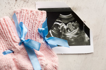 Knitted pink socks DIY for the child, lying on the picture ultrasound. Waiting for the child,...