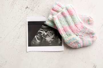 Knitted pink socks DIY for the child, lying on the picture ultrasound. Waiting for the child,...