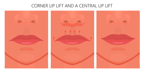 Vector illustration. Subnasal lip lift with Lateral Vermilion Advancements on face before, after procedure. Close up view. For advertising of medicinal, cosmetic, plastic surgery, procedures