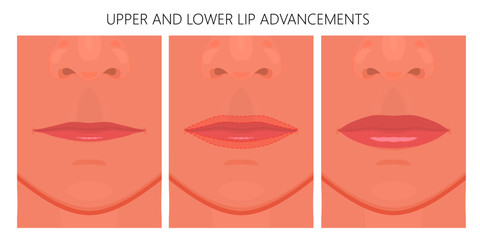 Vector illustration. Upper and Lower Lip Advancements on woman face before and after surgery. Close up view. For advertising of medicinal, cosmetic, plastic surgery, beauty procedures.
