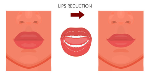 Vector illustration. Upper and lower  lip reduction before, after procedure. Close up view. For advertising of cosmetic plastic procedures; for medical and beauty publications