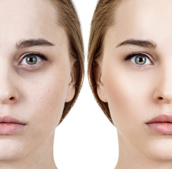 Woman with bruises under eyes before and after cosmetic treatment. - 248616140