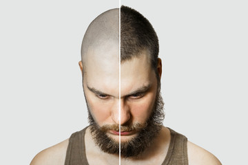 Man before and after hair loss, transplant on background