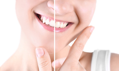 Smiling young woman before and after teeth whitening procedure on white background, closeup