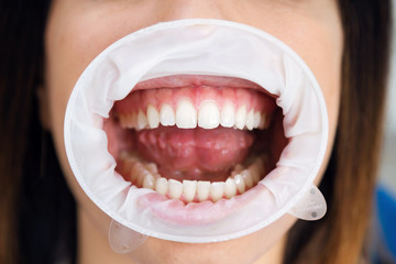 Young woman wearing mouth retractor waiting for oral examination in dentistry office.
