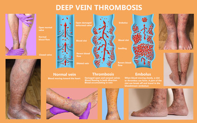 Economy class syndrome mechanism, deep vein thrombosis or DVT, Pulmonary Embolism, coronary thrombosis, diagram - obrazy, fototapety, plakaty