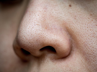 close up wide pores skin on dry face of Asian woman, Female nose and cheek skin problem, large...