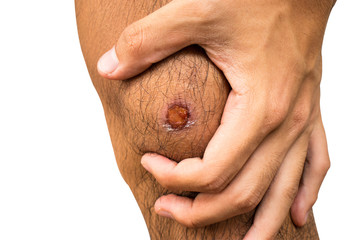 Hand holding on knee with scratch wound isolated on white background.