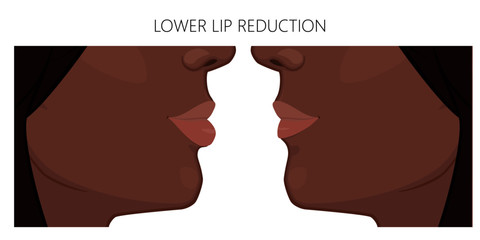 Fototapeta na wymiar Vector illustration. African American lower lip reduction before, after procedure. Close up view. For advertising of cosmetic plastic procedures; for medical and beauty publications