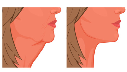 Vector illustration. A female face before, after plastic surgery - facial rejuvenation, face lift. Close up view. For advertising of cosmetological procedures, medical and beauty publications.