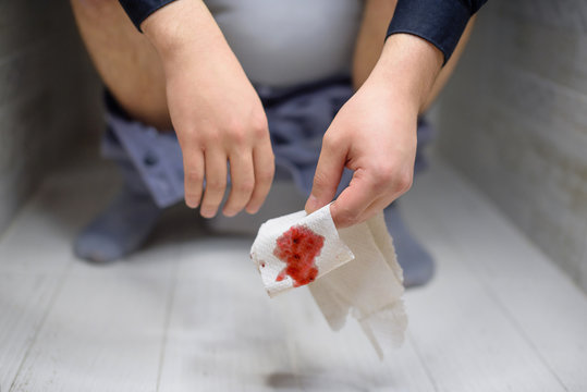 Man has stomach trouble, sitting on toilet bowl and has diarrhea or constipation or hemorrhoids. A man with his pants down is sitting on the toilet and holding bloody toilet paper.