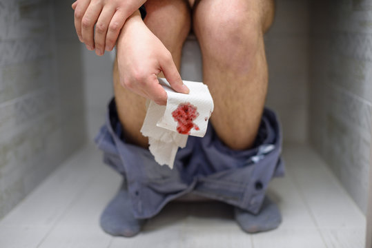 Man has stomach trouble, sitting on toilet bowl and has diarrhea or constipation or hemorrhoids. A man with his pants down is sitting on the toilet and holding bloody toilet paper.