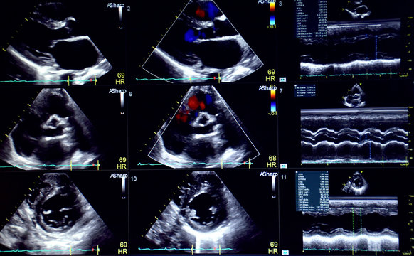  The 9 pictures of echocardiogram (ultrasound of haert).