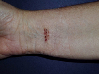 Scars on the hand after surgery and extraction. of medical neat