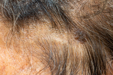 Black & Brown mole on senior woman's head, Medicine, Close up & Macro shot, Selective focus, Body...