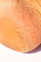 Woman' s heel break skin on white background, Close up & Macro shot, Asian Body skin part, Healthcare concept