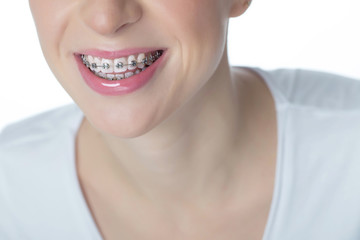 Woman with braces