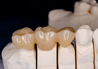 zirconia crowns on a plaster model, ready to be inserted